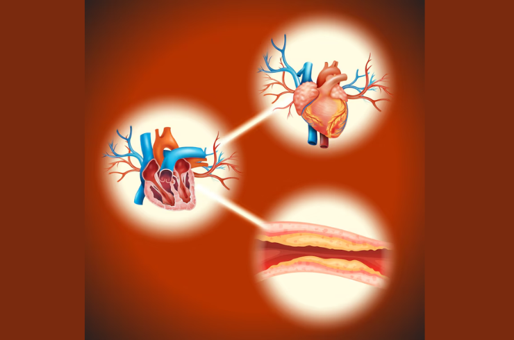 Coronary Artery Disease (CAD)